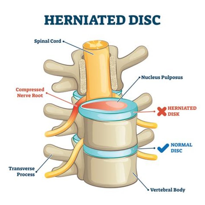 How painful are ruptured discs?