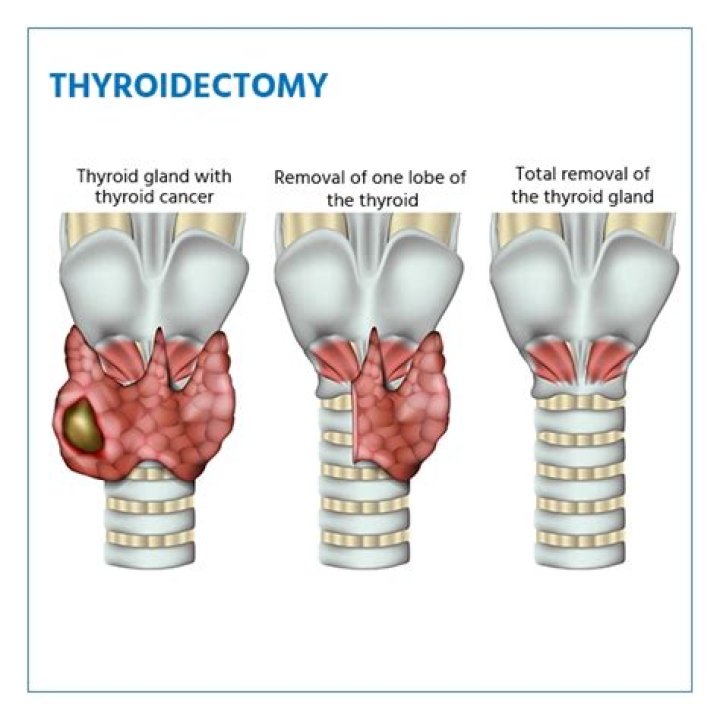 How quickly does calcium drop after parathyroidectomy?