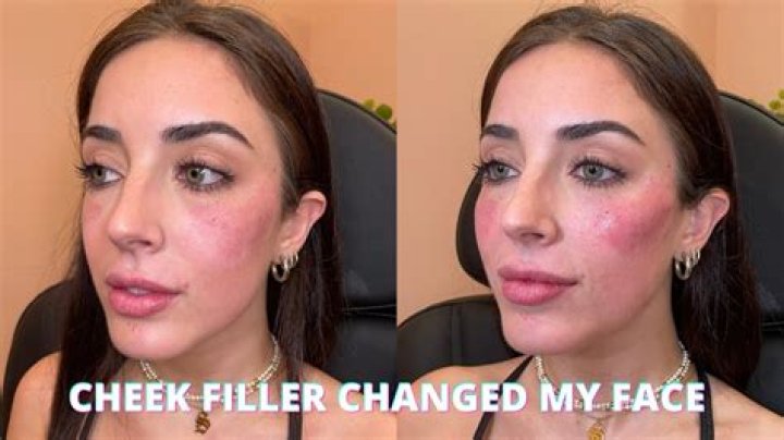 Is 1 syringe of Juvederm enough for cheeks?