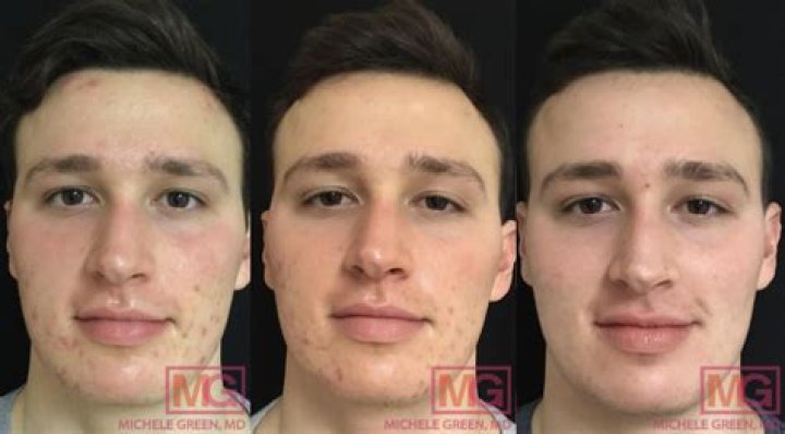 Is 5 months on Accutane enough?