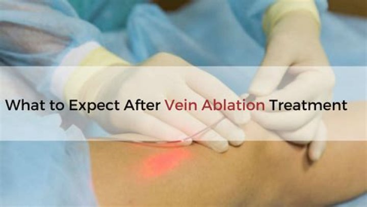 Is bruising normal after vein ablation?