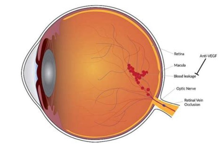 Is it bad when a vein pops in your eye?