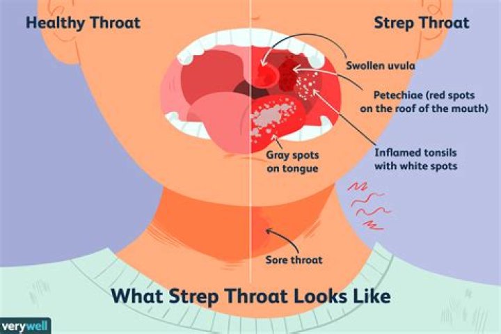Is strep c serious?