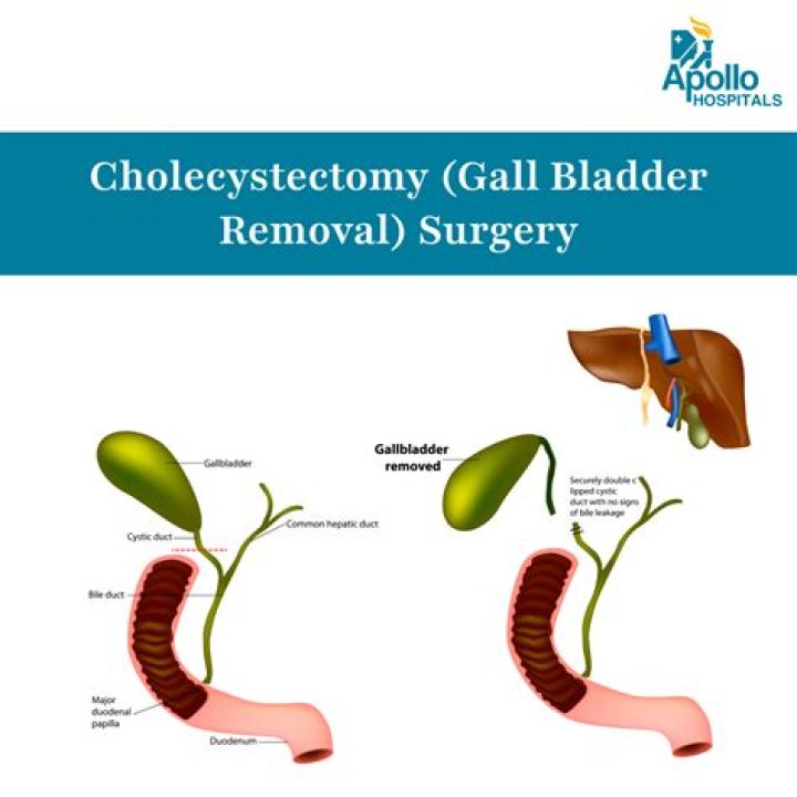Is there any problem in pregnancy after gallbladder removal?