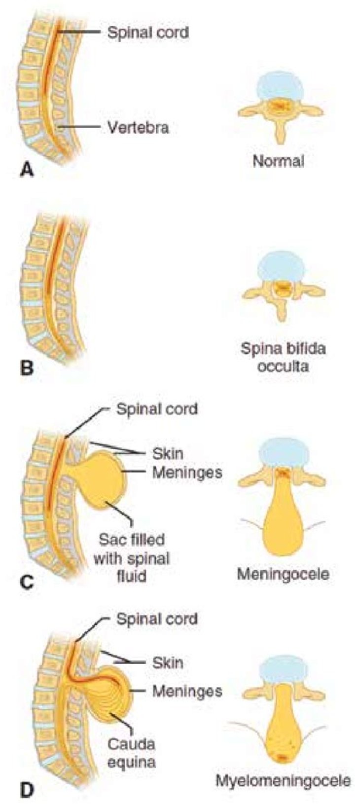 What are the 4 types of spina bifida?