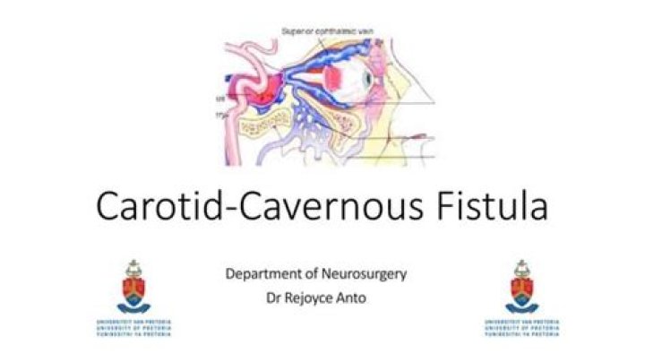 What are the main clinical signs of direct carotid cavernous fistula?