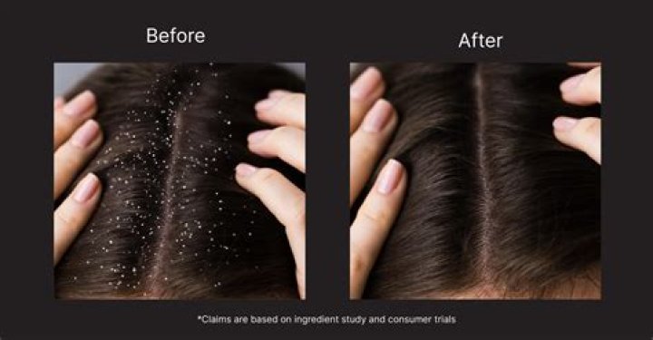 What are the side effects of anti dandruff shampoo?