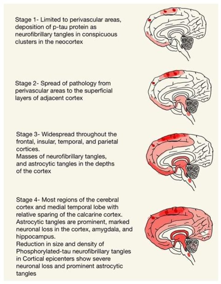 What are the stages of encephalopathy?