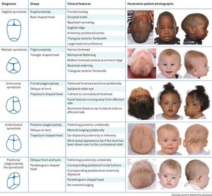 What are the symptoms of Synostosis?