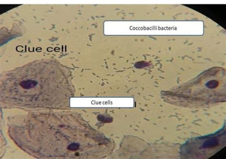 What bacteria causes clue cells?