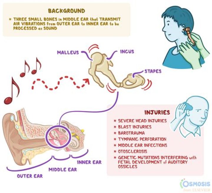 What can cause Micropsia?