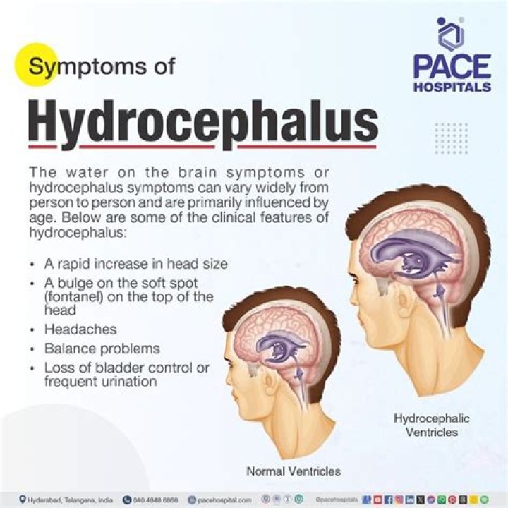 What can hydrocephalus be mistaken for?
