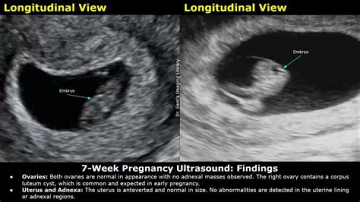 What can I expect to see at a 7 week ultrasound?