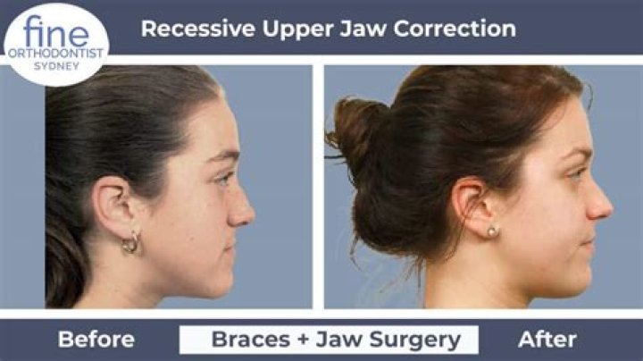 What causes an underdeveloped upper jaw?