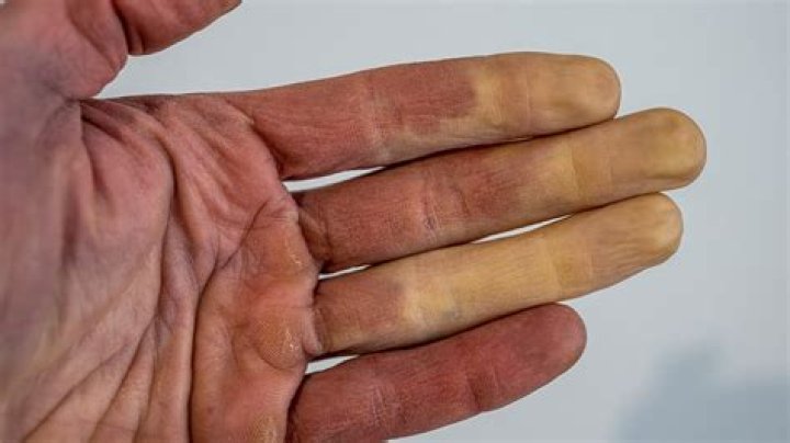 What causes blue cold fingers?
