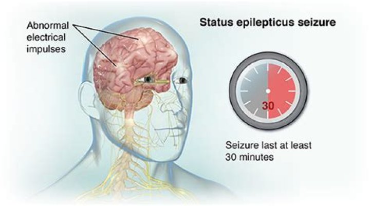 What causes convulsive status epilepticus?