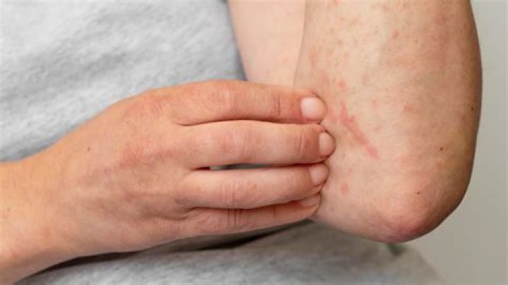 What do allergy bumps look like?