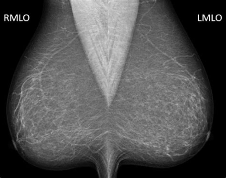 What does a Category 1 mammogram mean?