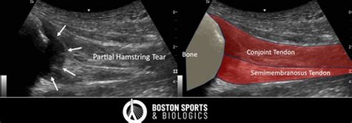 What does a partial tear of hamstring feel like?