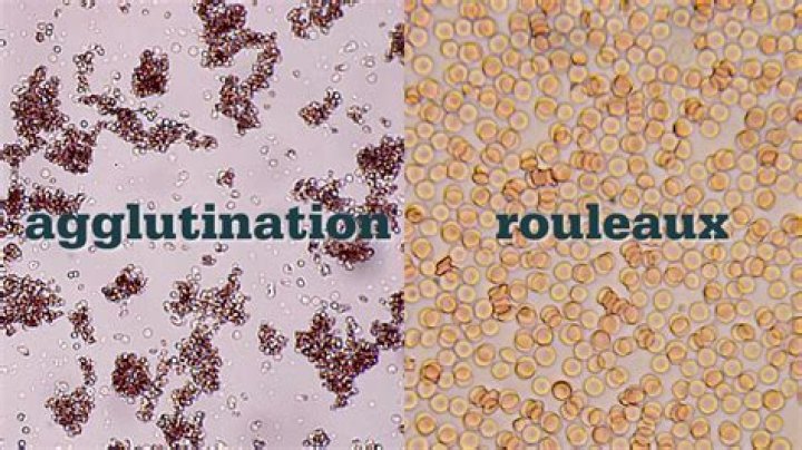 What does a positive saline agglutination test suggest?