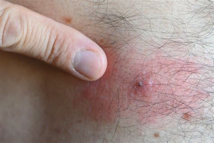 What does an infected tick bite look like on a dog?