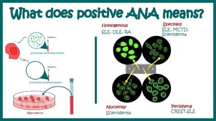 What does ANA pattern speckled mean?