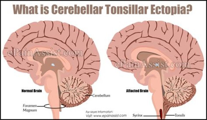 What does cerebellar tonsillar ectopia mean?