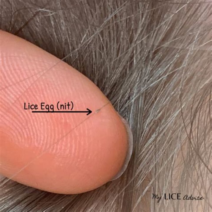 What does eggs from head lice look like?