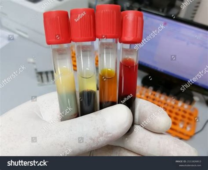 What does it mean when a blood sample is icteric?