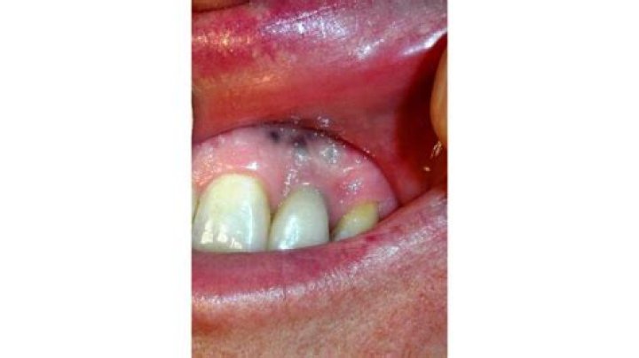What does melanoma look like in the mouth?