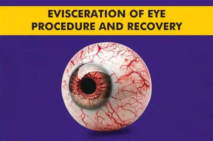 What happens after eye evisceration?