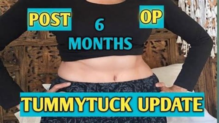 What happens at 6 months after tummy tuck?
