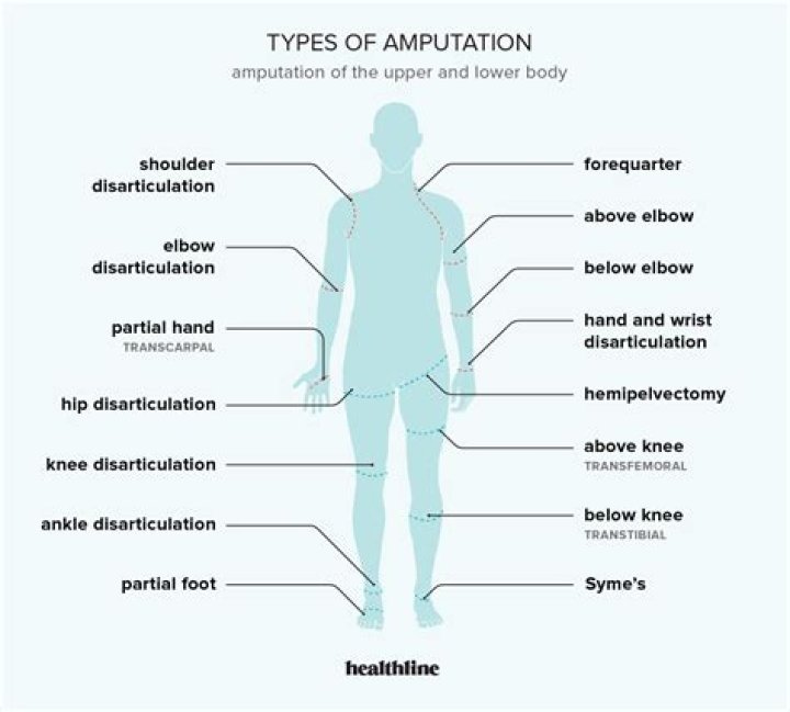 What happens when you amputate an arm?