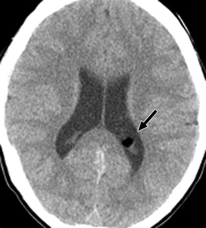 What is a choroid plexus lipoma?