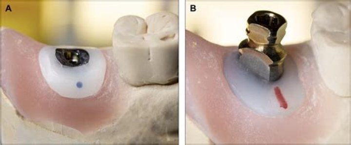 What is a custom healing abutment?