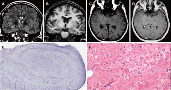 What is a gangliocytoma?