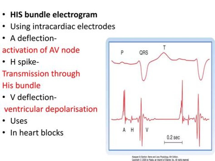 What is a His bundle Electrogram?