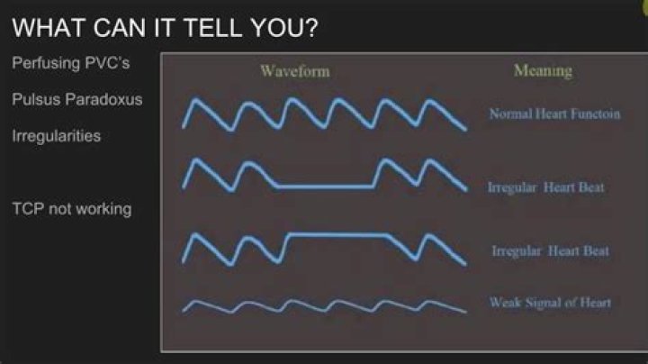 What is a normal Pleth reading?