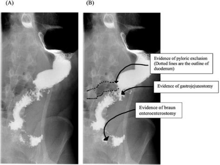 What is a pyloric exclusion procedure?
