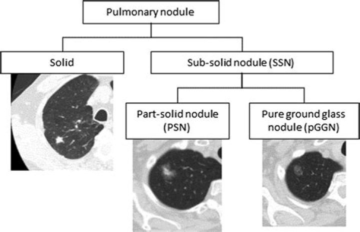 What is a Subsolid pulmonary nodule?