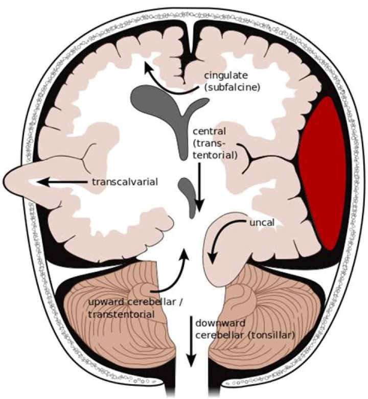 What is a Tentorial tear?