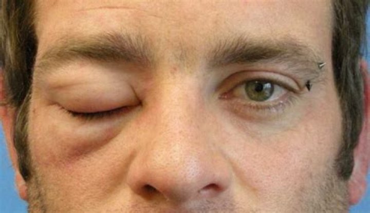 What is acquired angioedema?