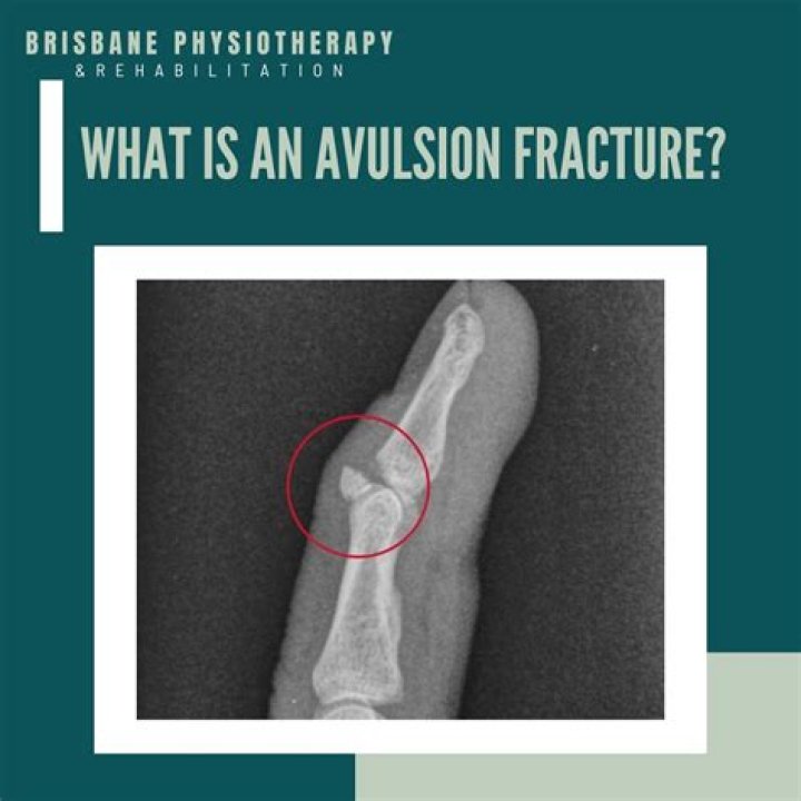 What is an avulsion injury?