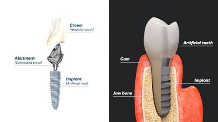 What is an electronic implants in mouth?