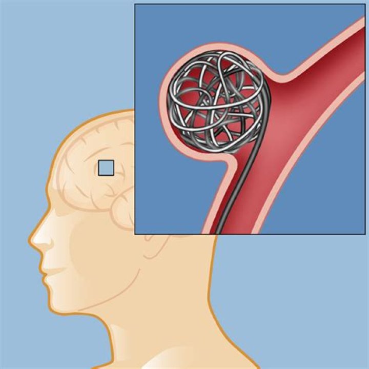 What is an embolization procedure of the brain?