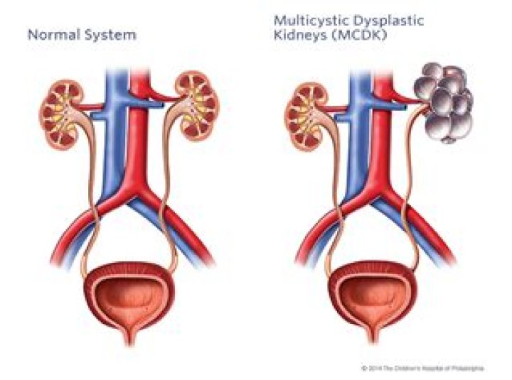 What is cystic dysplastic kidney?