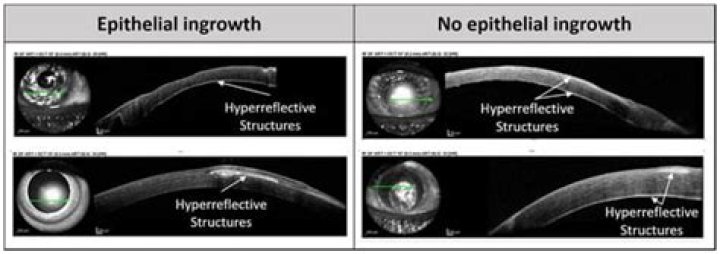 What is epithelial ingrowth in the eye?