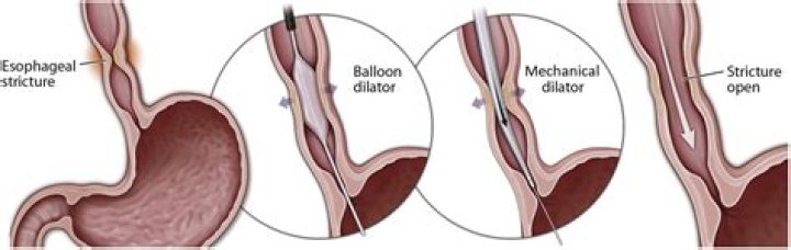 What is esophageal Bougienage?