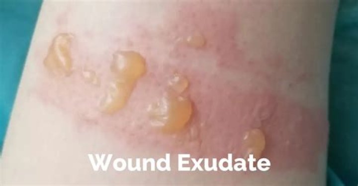What is exudate wound?