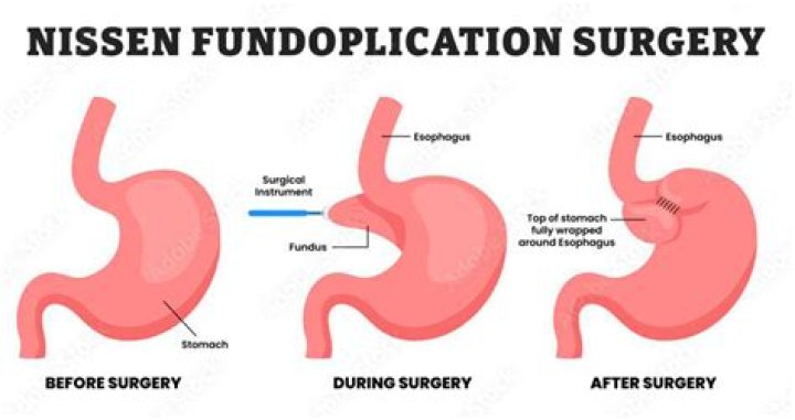What is floppy Nissen fundoplication?